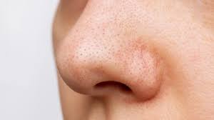 Effective-Tips-to-Minimize-Pores